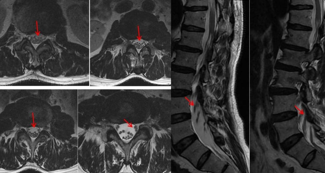 运动神经元病最新治疗方案深度研究